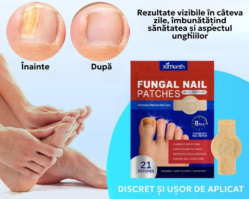 Plasturi antifungici & antibacterieni pentru unghii, tratament micoză/onicomicoză, acțiune 8h peste noapte, reparare și regenerare, 21 Buc