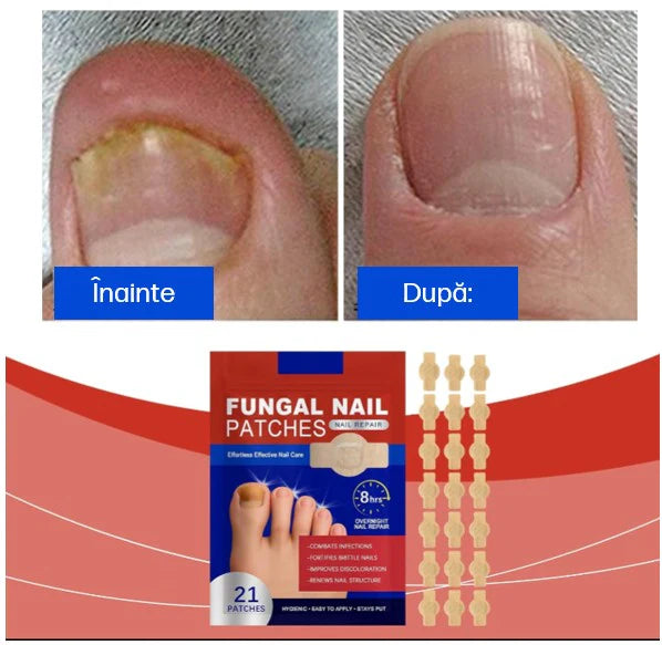 Plasturi antifungici & antibacterieni pentru unghii, tratament micoză/onicomicoză, acțiune 8h peste noapte, reparare și regenerare, 21 Buc